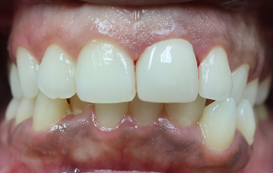Close up of a smile after whitening and straightening the teeth