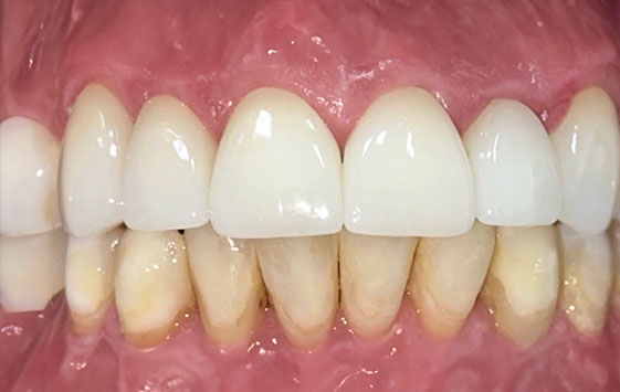 Close up of a mouth with evenly aligned teeth