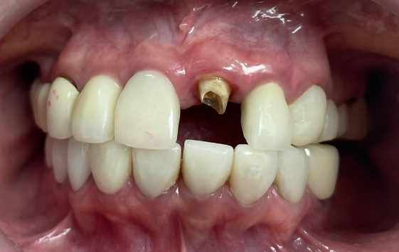 Close up of a mouth with slightly gapped teeth