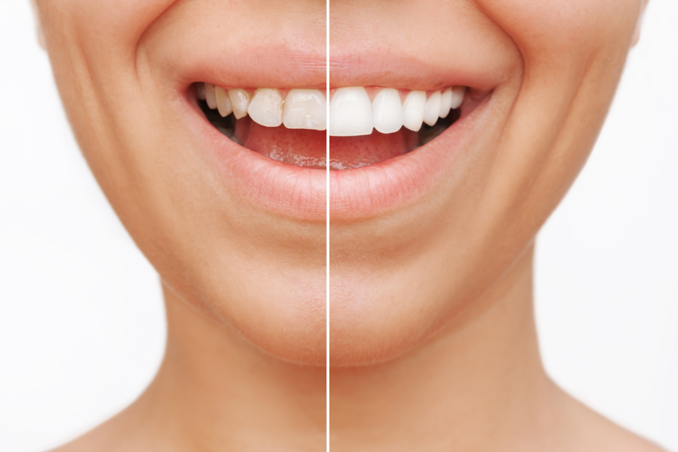 a woman's mile before and after getting veneers 